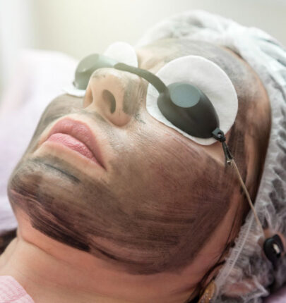 Carbon-Facial-1 Carbon-Facial-1