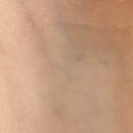 Laser Tattoo Removal – Arm After Laser Tattoo Removal Oxford - Arm After. Bare UK Oxford