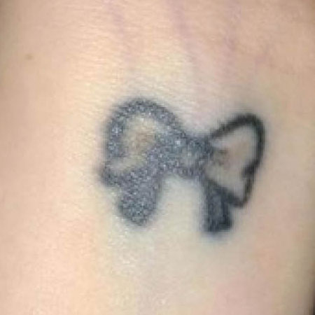 Laser Tattoo Removal – Arm Before Laser Tattoo Removal Oxford - Arm Before. Bare UK Oxford