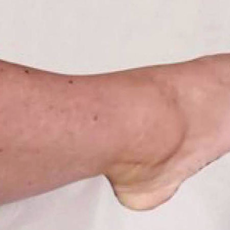 Laser Tattoo Removal – Foot After Laser Tattoo Removal Oxford - Foot After. Bare UK Oxford.
