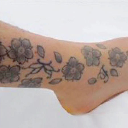 Laser Tattoo Removal – Foot Before Laser Tattoo Removal Oxford - Foot Before. Bare UK Oxford.