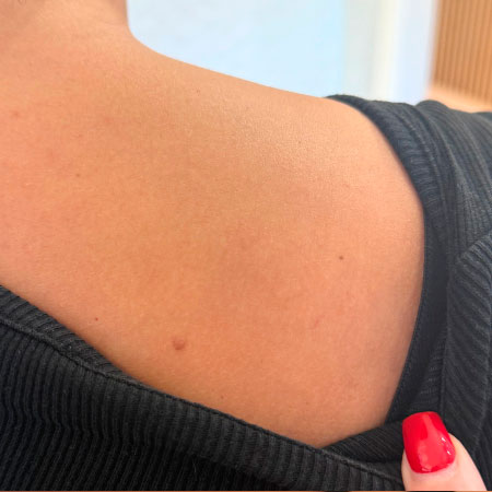 Tattoo Removal Oxford – Shoulder After Tattoo Removal Oxford - Shoulder After. Bare UK Oxford