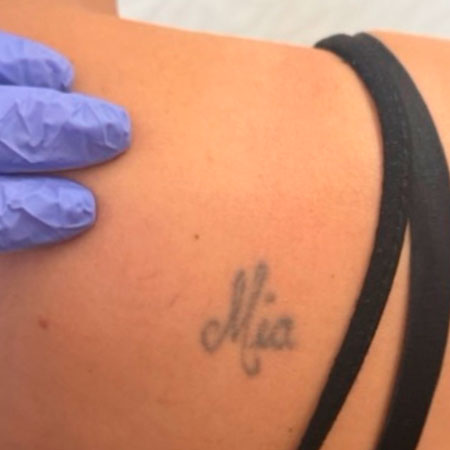 Tattoo Removal Oxford – Shoulder Before Tattoo Removal Oxford - Shoulder Before. Bare UK Oxford